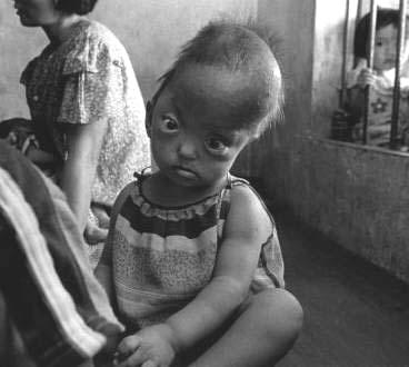 En cuanto a los ni�os, 154,000 nacieron con diferentes tipos de malformaciones, 10,000 murieron